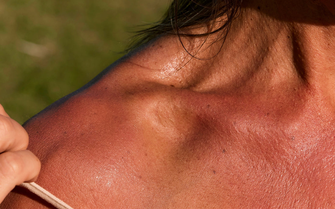 Why Moringa Oil Is Good for Sunburn and Sun-Damaged Skin