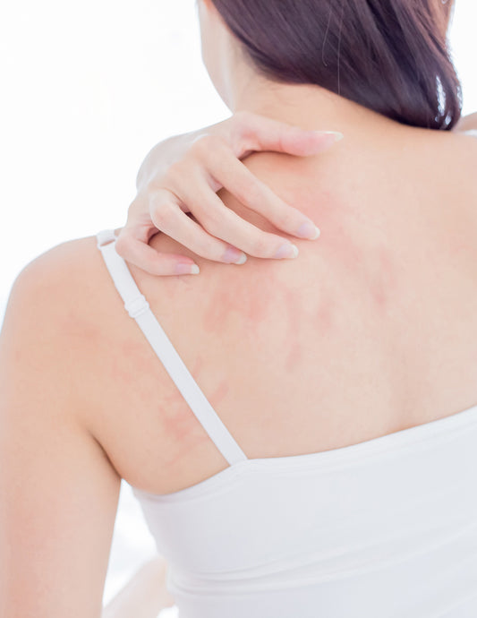 Hello moringa, goodbye eczema